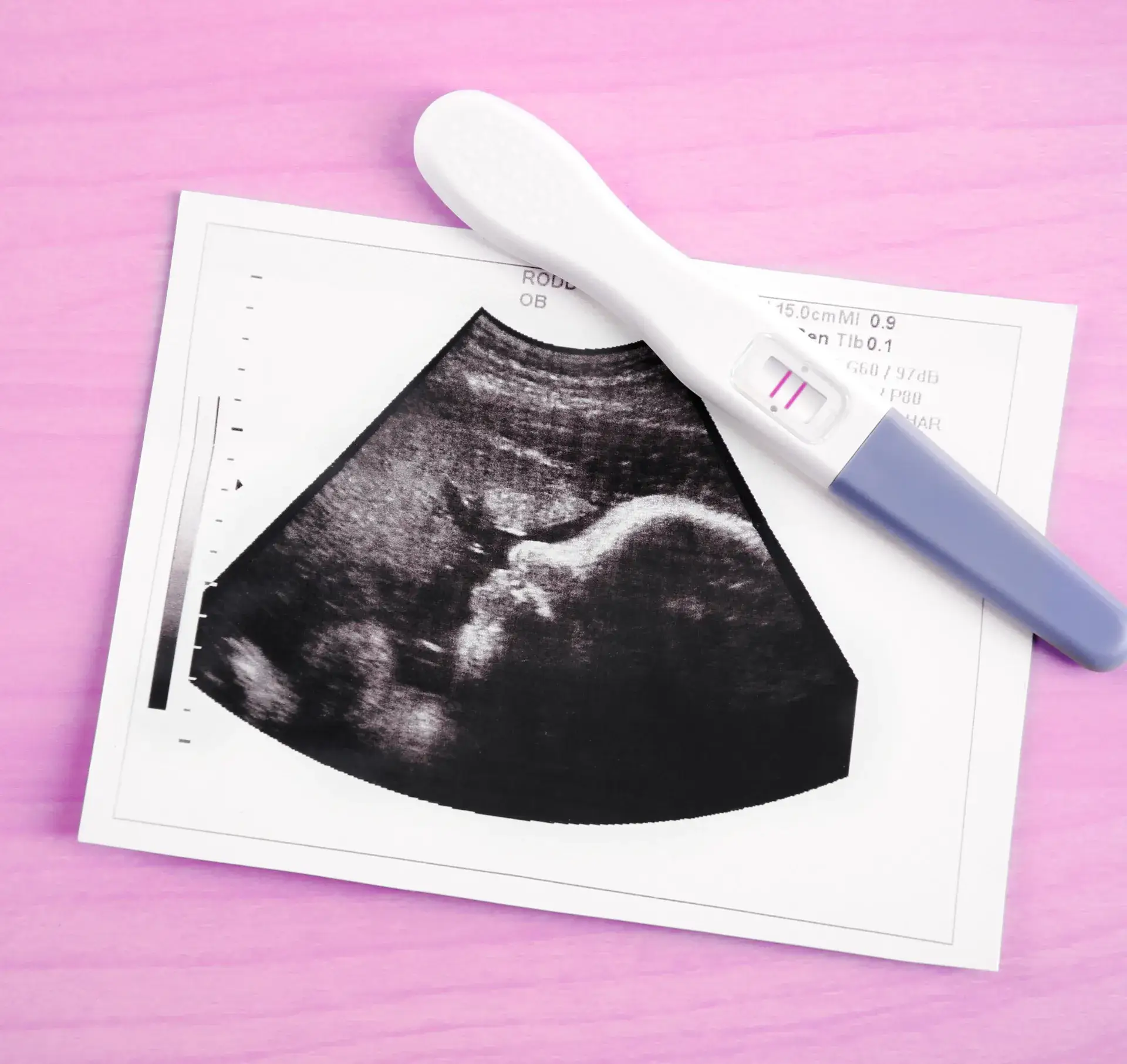 Ultrasound scan of a foetus at Nest Fetal Medicine Centre